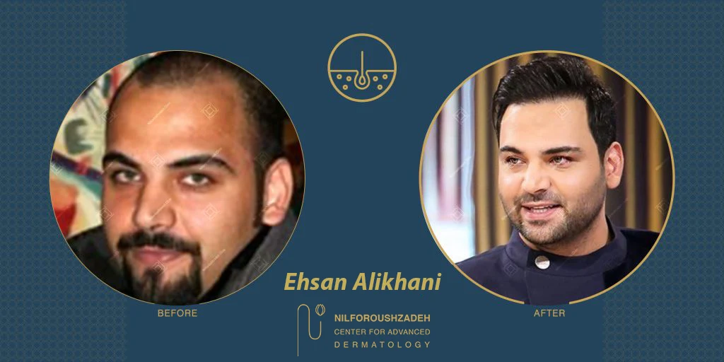 Ehsan-Ali-khani-hair-transplant