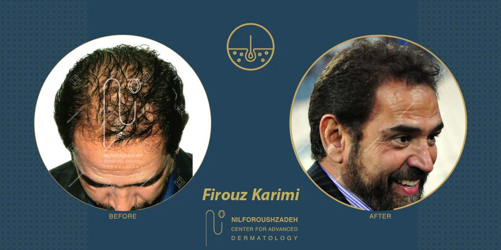 Firouz-Karimi-hair-transplant