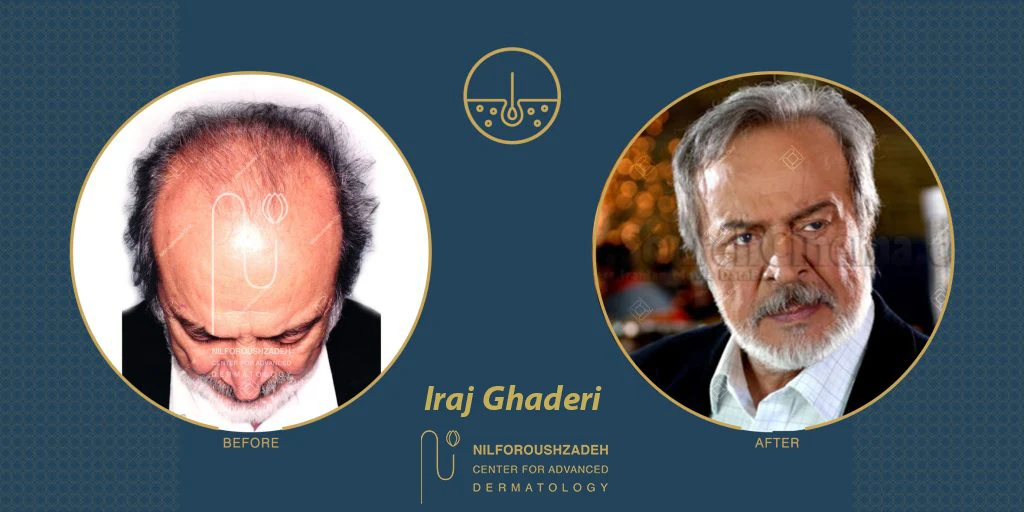 Iraj-Ghaderi-hair-transplant