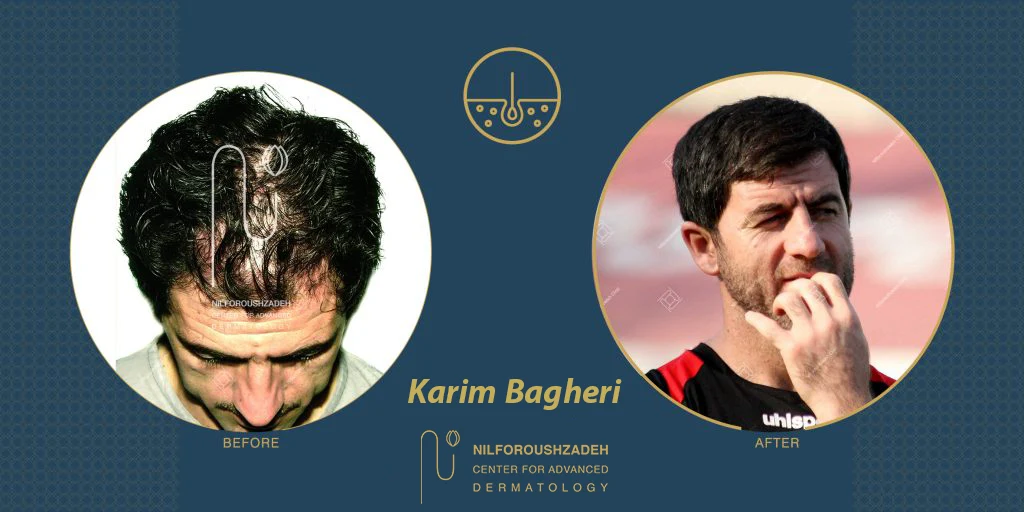 Karim-Bagheri-hair-transplant