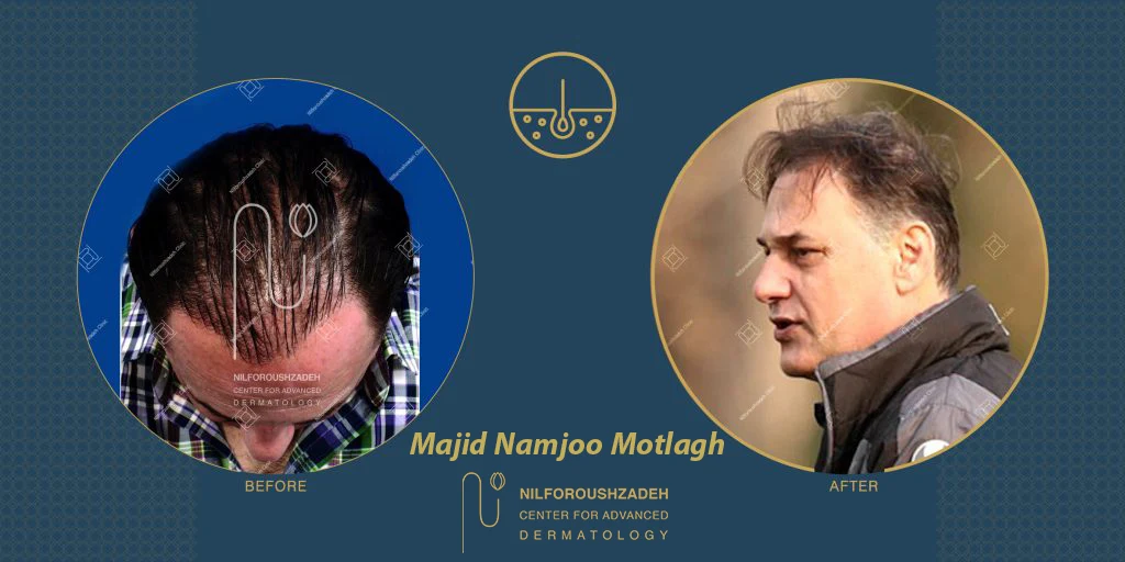 Majid-Namjoo-Motlagh-hair-transplant