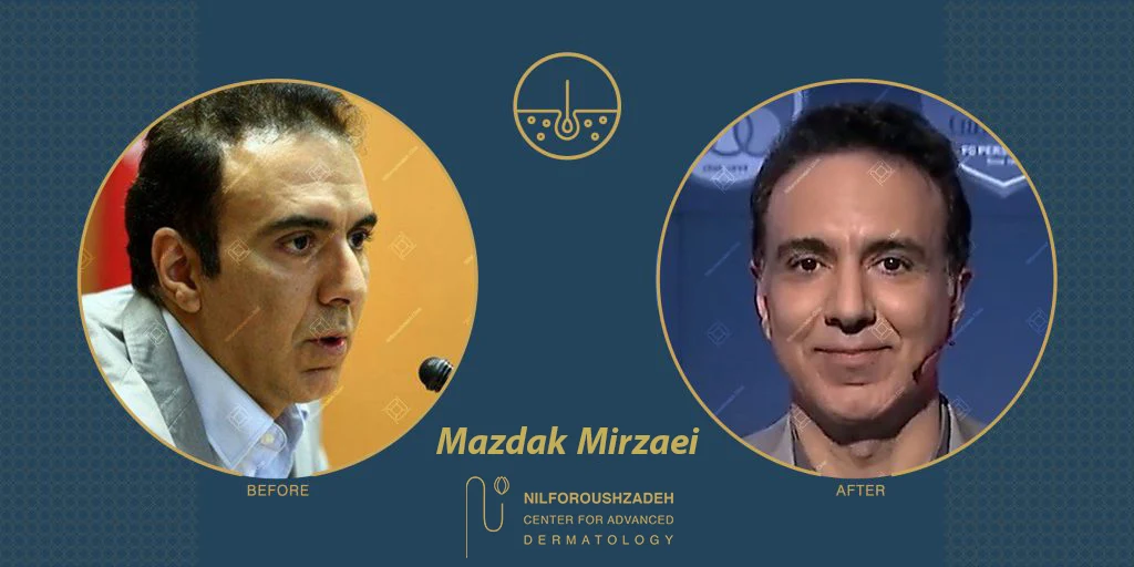 Mazdak-Mirzaei-hair-transplant