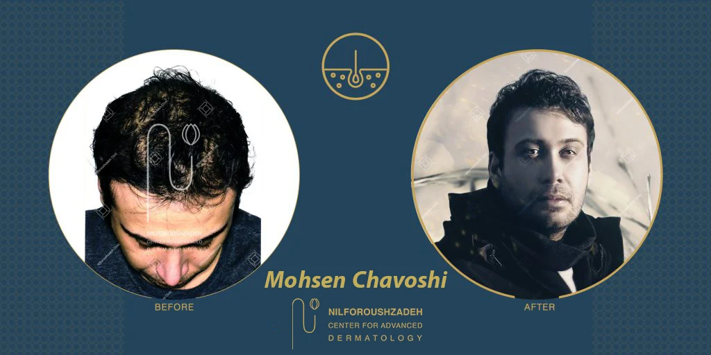 Mohsen-Chavoshi-hair-transplant