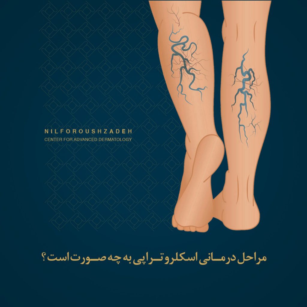 اسکلروتراپی واریس پا