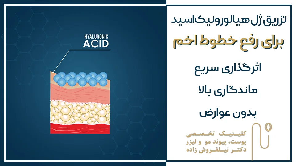 تزریق ژل برای رفع خط اخم