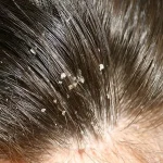 ایجاد شوره در موهای خشک یا چرب