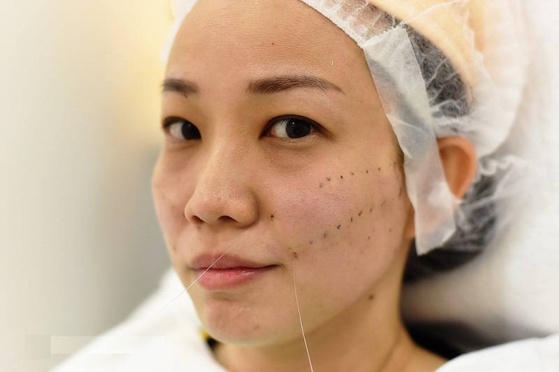 لیفت صورت با نخ