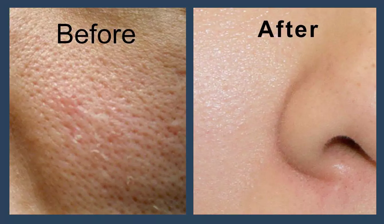 قبل و بعد درمان منافذ باز پوست