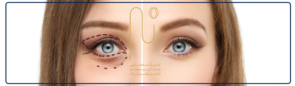 بلفارو-دور-چشم-بدون-جراحی