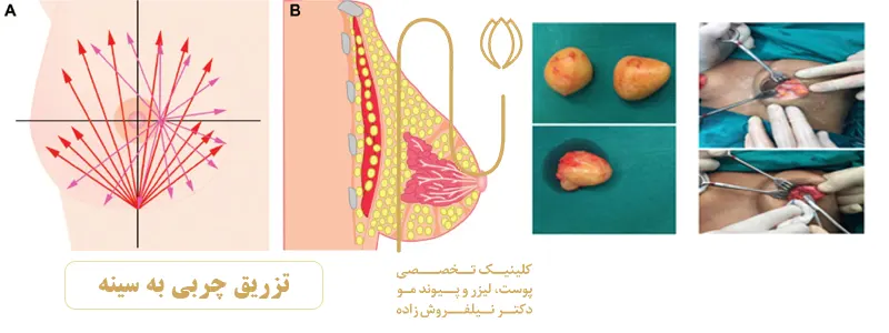 تزریق-چربی-بهتره-یا-پروتز