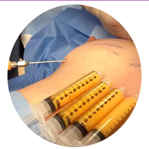 عوارض-تزریق-چربی-به-سینه