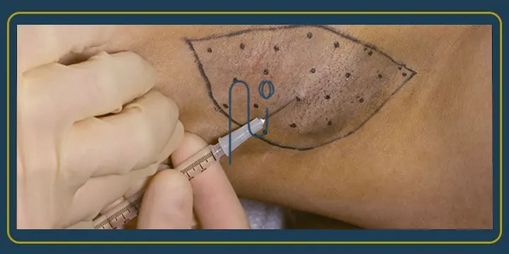 عکس-بوتاکس-زیر-بغل-1