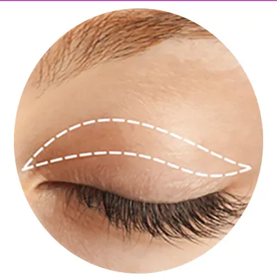 لیفت-و-بلفارو-چشم-بدون-جراحی