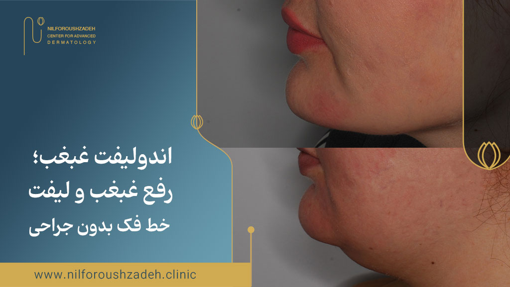 اندولیفت غبغب؛ رفع غبغب و لیفت خط فک بدون جراحی