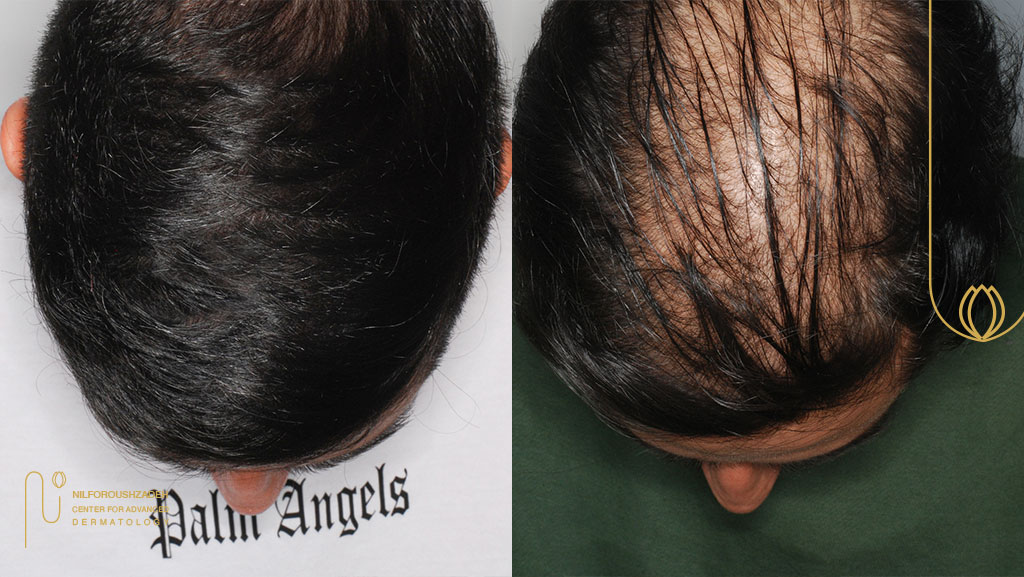 مراقبت های بعد از کاشت مو