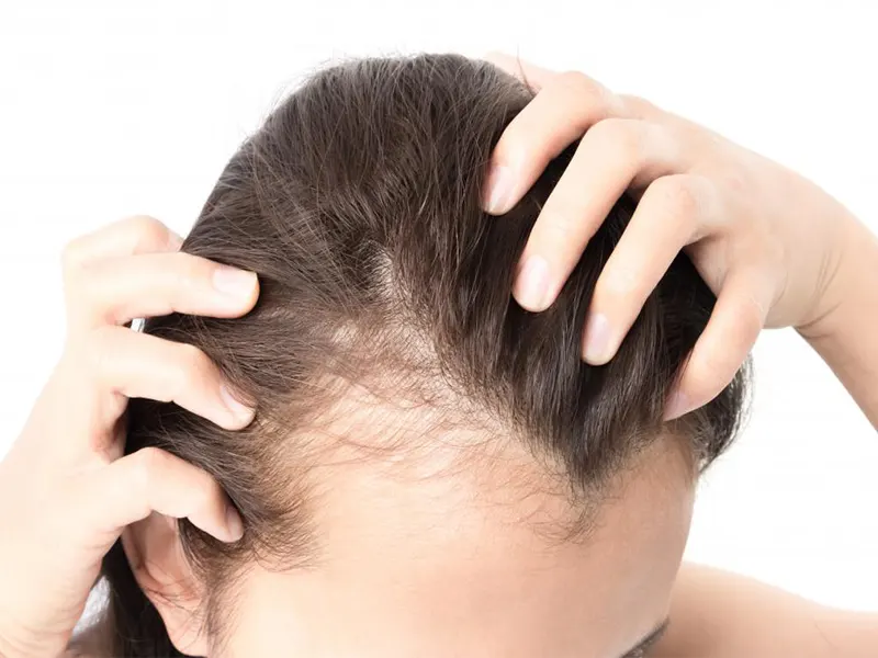 کلینیک درمان ریزش مو