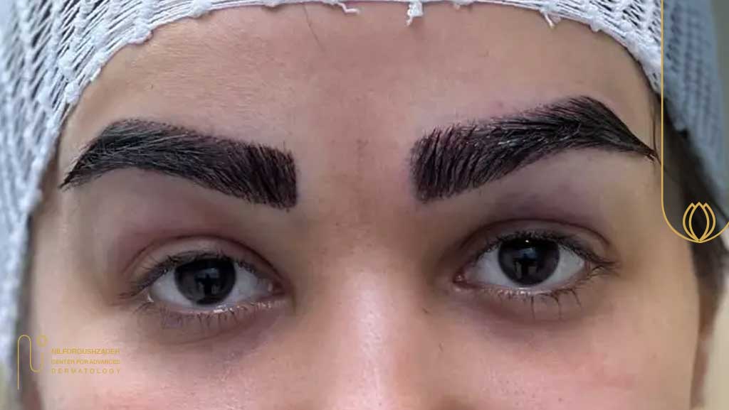 درمان خونریزی و تورم بعد از کاشت ابرو