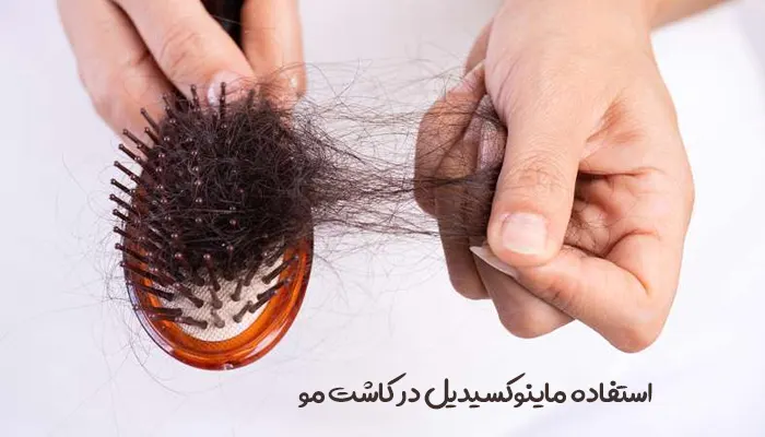 استفاده ماینوکسیدیل در کاشت مو