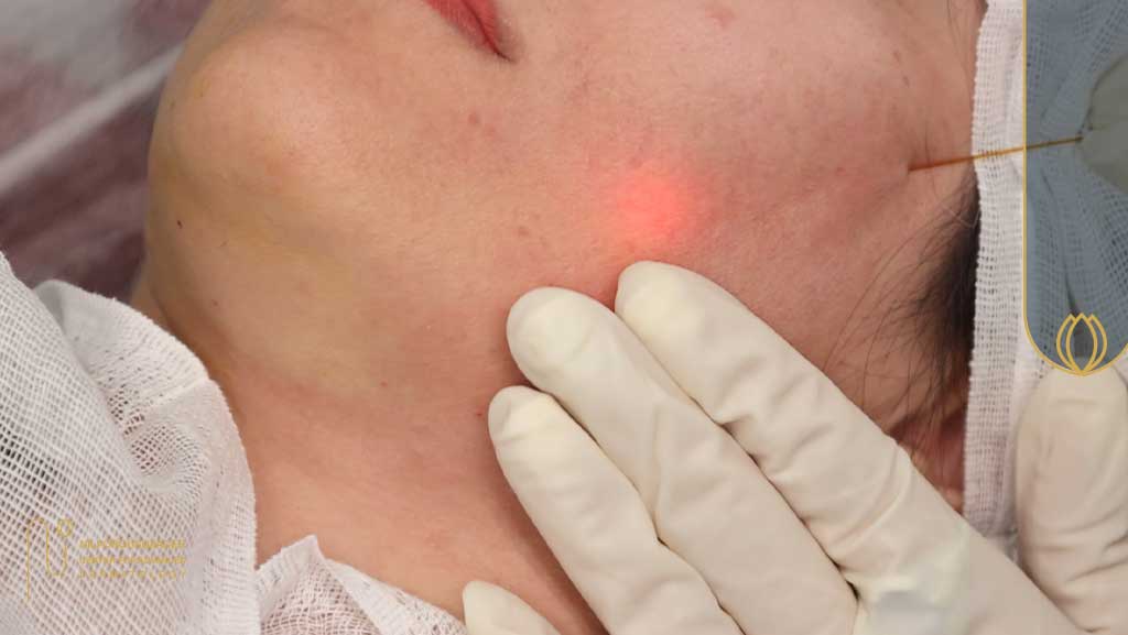 موارد استفاده از اندولیفت شامل لیفت و چربی سوزی