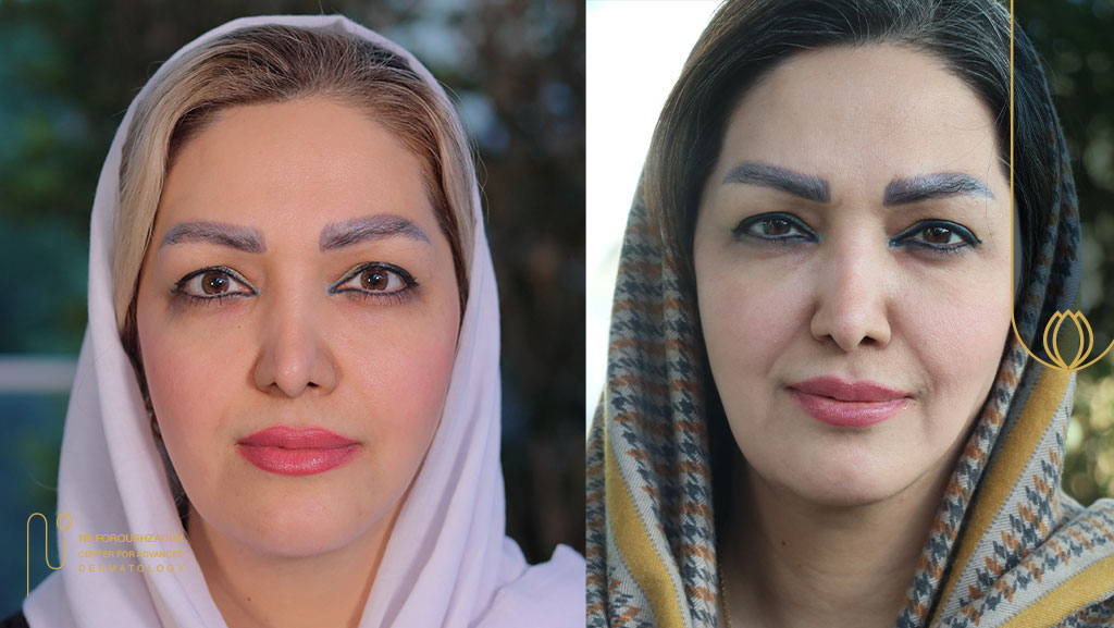 مناطق قابل درمان با اندولیفت