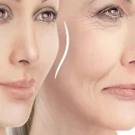 عوارض تزریق چربی به صورت