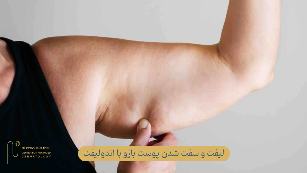 لیفت و سفت شدن پوست بازو با اندولیفت