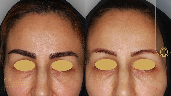 کاشت ابرو کلینیک نیلفروش زاده