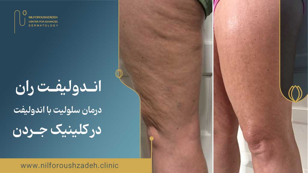اندولیفت ران، درمان سلولیت با اندولیفت