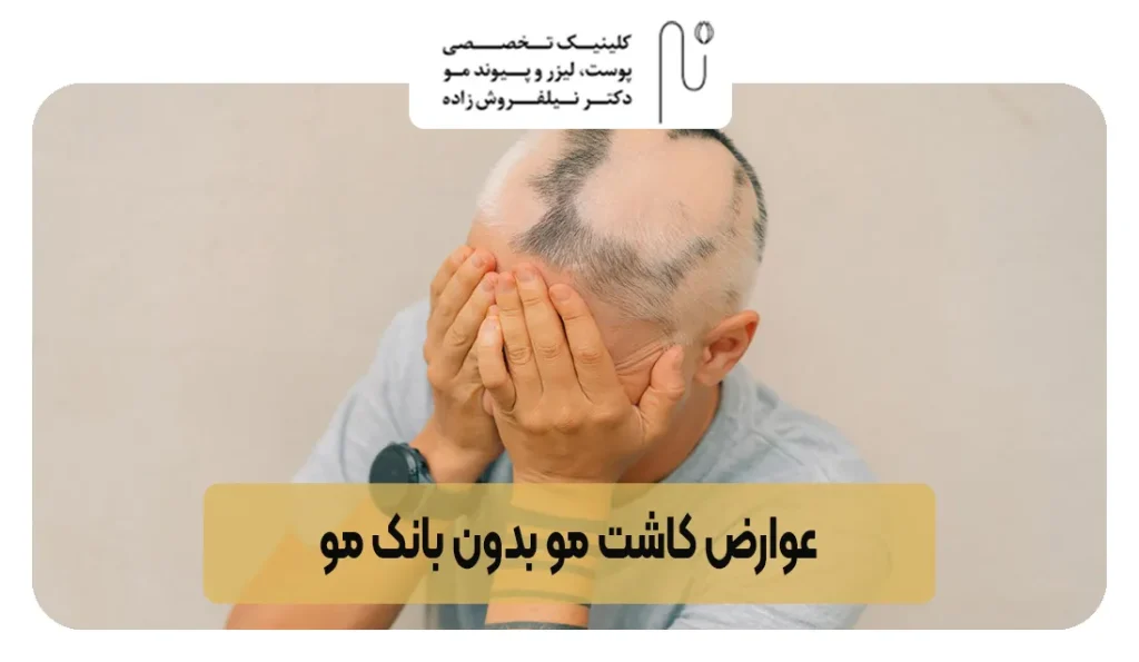 عوارض کاشت مو بدون بانک مو | کلینیک نیل فروش زاده