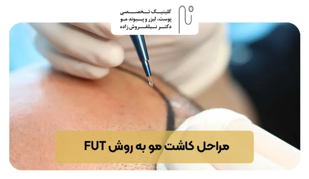 FUT hair transplant steps 11zon