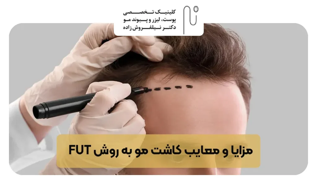 FUT hair transplantation in 5 steps 11zon