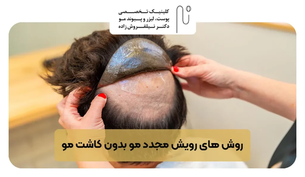 روش های رویش مجدد مو بدون کاشت مو | کلینیک نیل فروش زاده