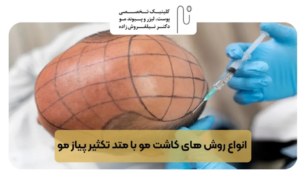 انواع روش های کاشت مو با متد تکثیر پیاز مو | کلینیک نیل فروش زاده