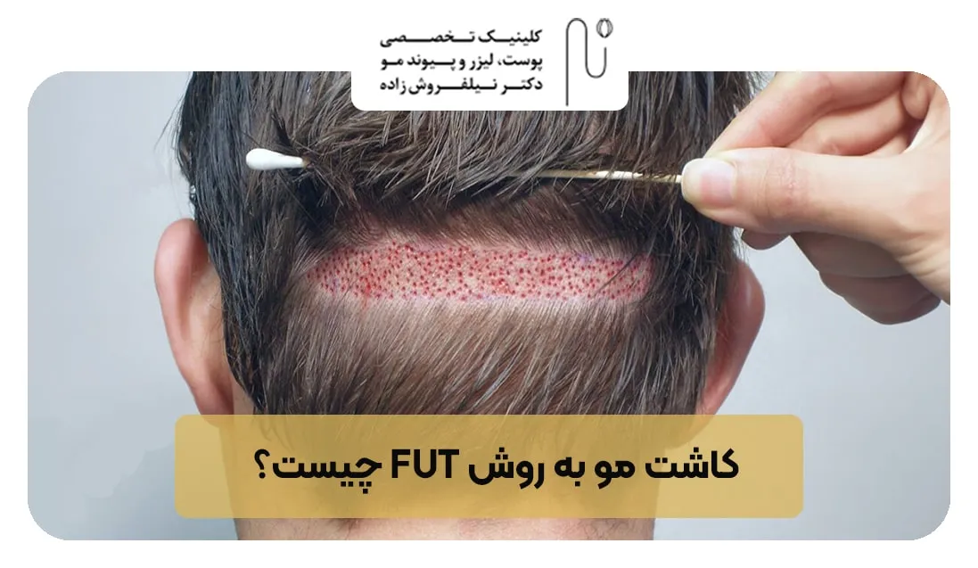 کاشت مو به روش fut چیست | کلینیک نیل فروش زاده