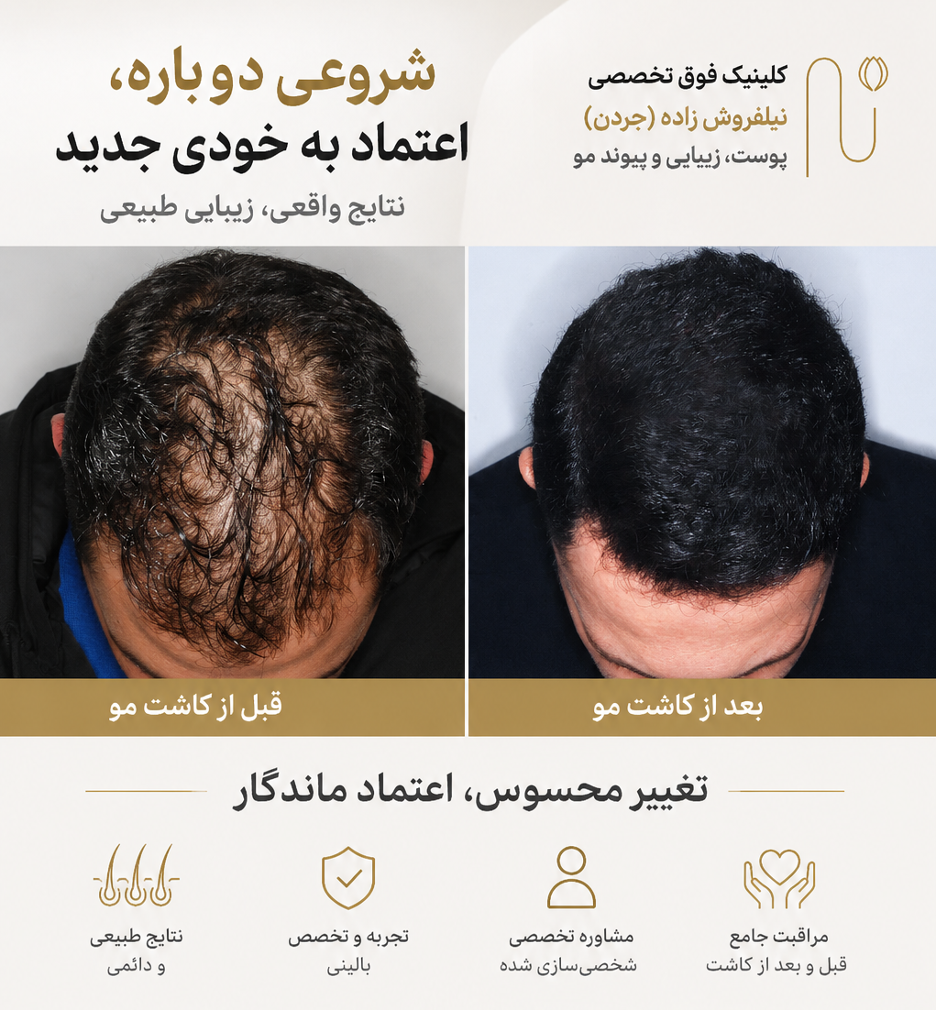 کاشت مو برای مردان