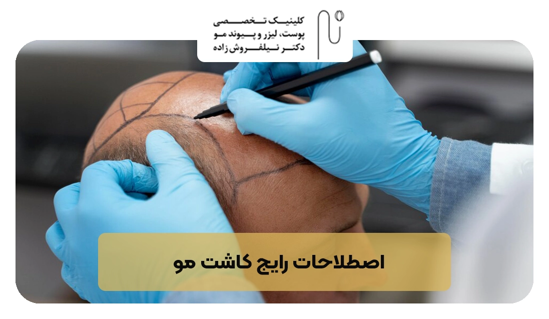 اصطلاحات رایج کاشت مو | کلینیک نیلفروش زاده