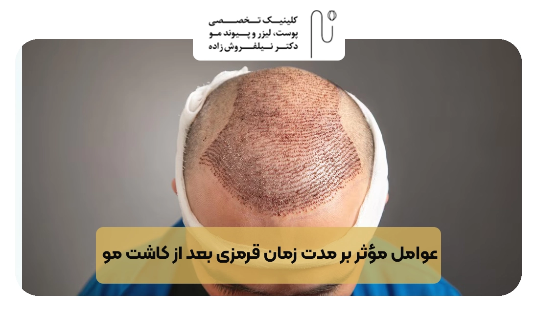 عوامل مؤثر بر مدت زمان قرمزی بعد از کاشت مو | کلینیک نیلفروش زاده