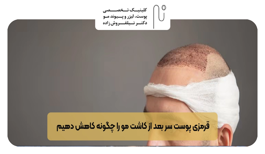 قرمزی پوست سر بعد از کاشت مو را چگونه کاهش دهیم | کلینیک نیلفروش زاده