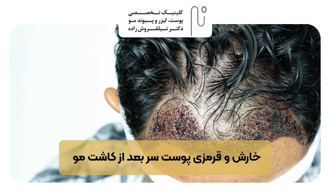  خارش و قرمزی پوست سر بعد از کاشت مو | کلینیک نیلفروش زاده