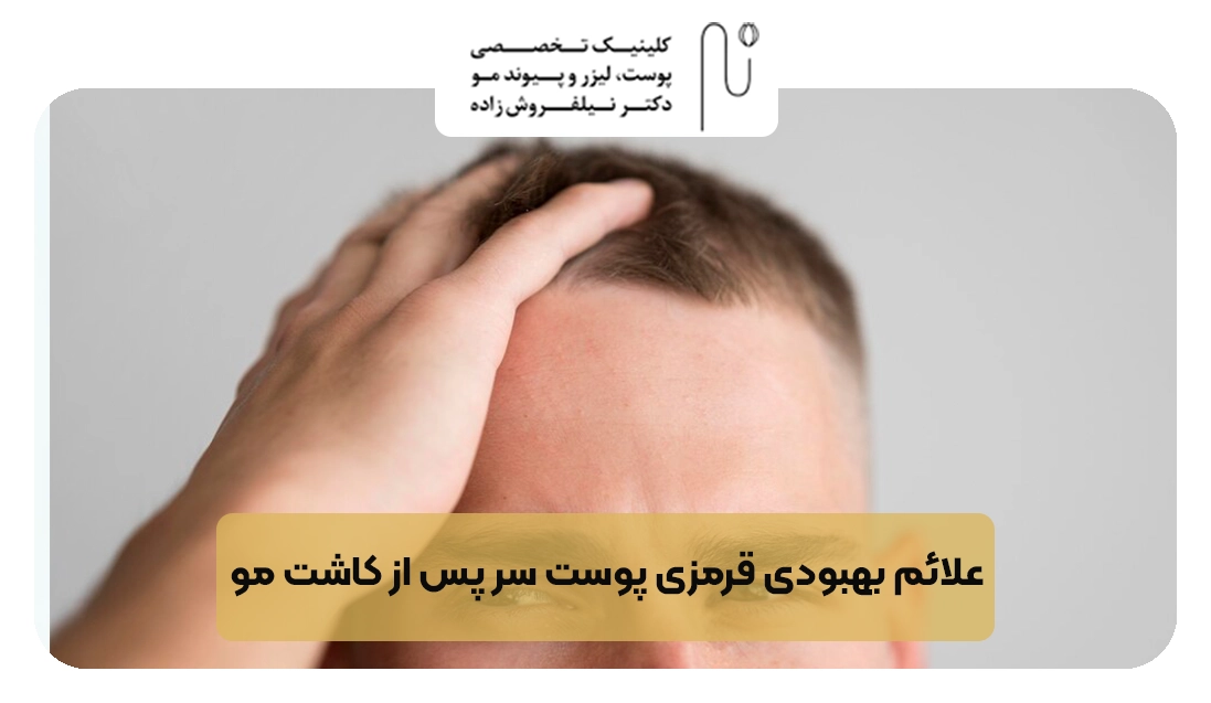 علائم بهبودی قرمزی پوست سر پس از کاشت مو | کلینیک نیلفروش زاده