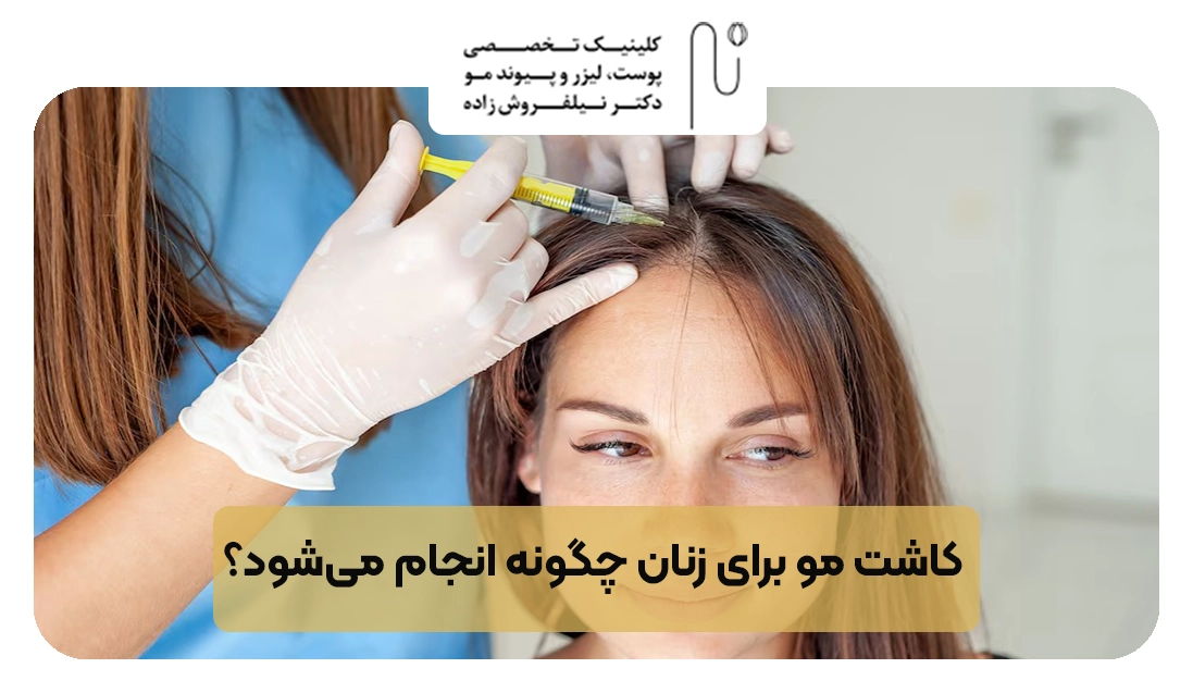 کاشت مو برای زنان