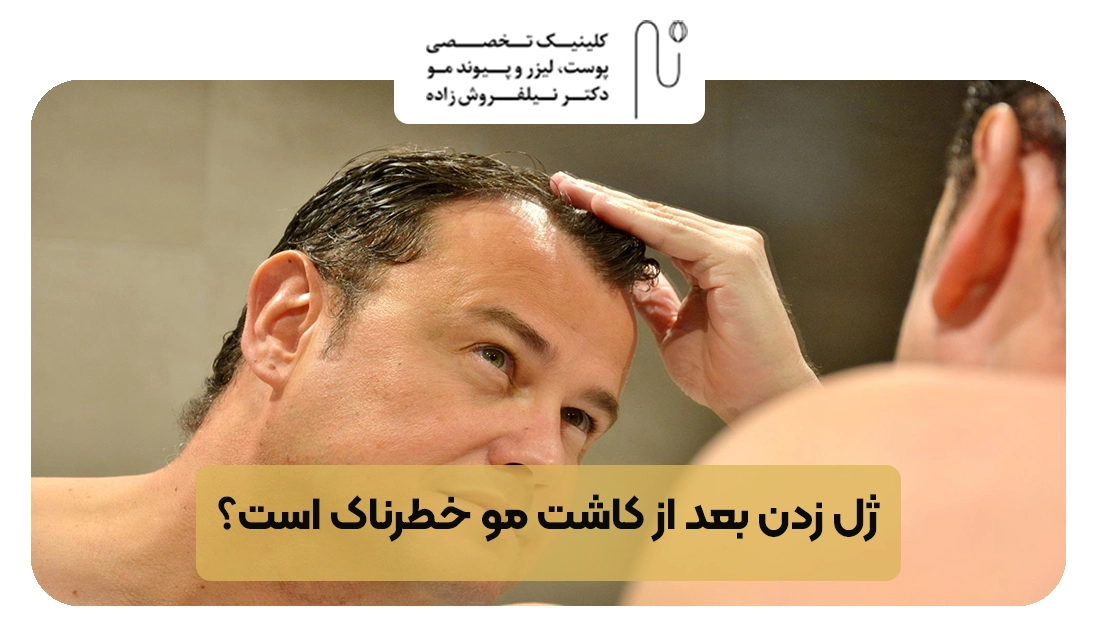 ژل زدن بعد از کاشت مو خطرناک است | کلینیک نیل فروش زاده