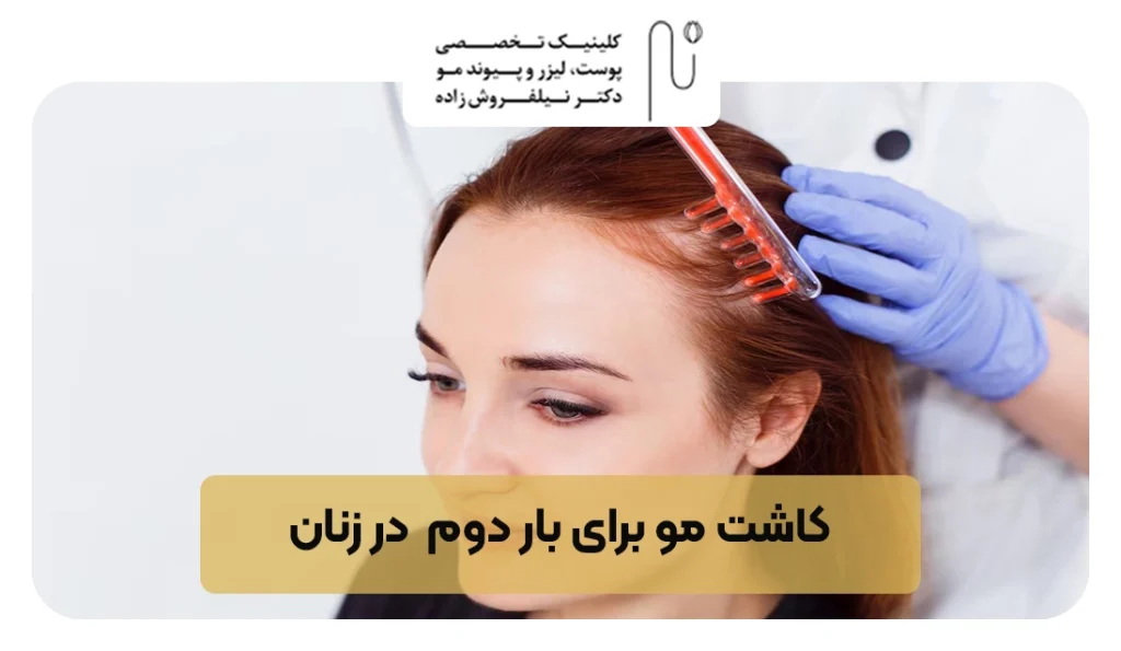 کاشت مو برای بار دوم  در زنان  | کلینیک نیل فروش زاده