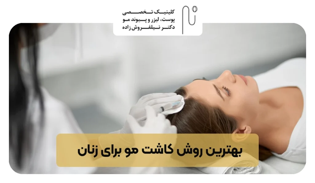 بهترین روش کاشت مو برای زنان | کلینیک نیل فروش زاده