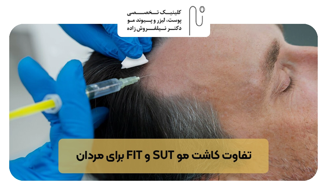 تفاوت کاشت مو fit و sut برای مردان | کلینیک نیلفروش زاده