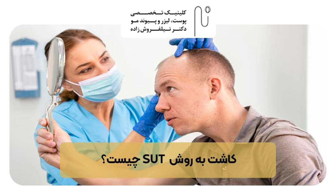 کاشت به روش sut چیست ؟ | کلینیک نیلفروش زاده
