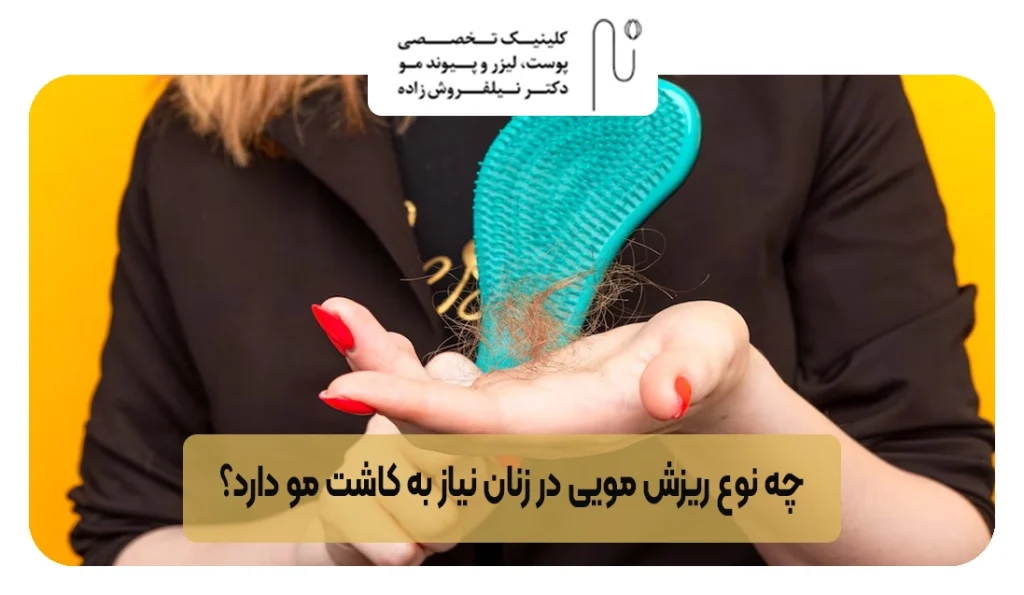 چه نوع ریزش مویی در زنان نیاز به کاشت مو دارد؟ | کلینیک نیل فروش زاده