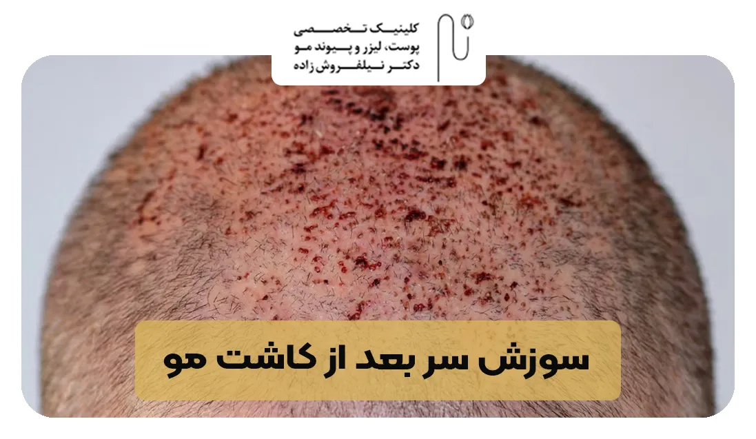 سوزش سر بعد از کاشت مو | کلینیک نیلفروش زاده