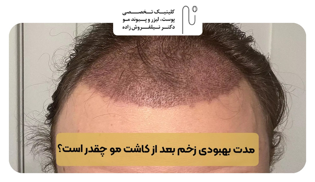 مدت بهبودی زخم بعد از کاشت مو چقدر است؟ | کلینیک نیلفروش زاده