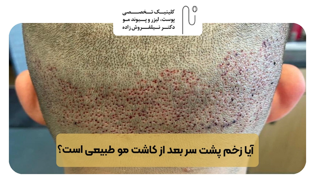 آیا زخم پشت سر بعد از کاشت مو طبیعی است؟ | کلینیک نیلفروش زاده